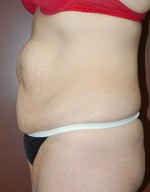Abdominoplasty