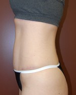Abdominoplasty