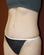 Abdominoplasty