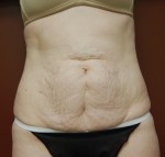 Abdominoplasty