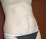 Abdominoplasty