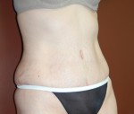 Abdominoplasty