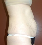 Abdominoplasty