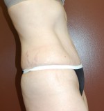Abdominoplasty