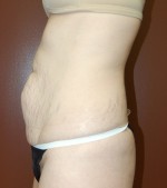 Abdominoplasty