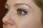 Eyelid Surgery - Blepharoplasty