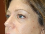 Eyelid Surgery - Blepharoplasty