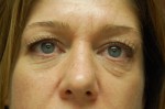 Eyelid Surgery - Blepharoplasty