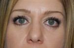 Eyelid Surgery - Blepharoplasty