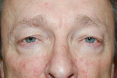 Eyelid Surgery - Blepharoplasty Case 3312 Before Photo Eyelid Surgery - Blepharoplasty