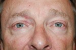 Eyelid Surgery - Blepharoplasty