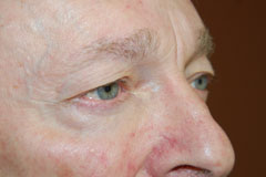 Eyelid Surgery - Blepharoplasty