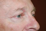Eyelid Surgery - Blepharoplasty