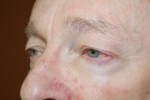Eyelid Surgery - Blepharoplasty