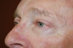 Eyelid Surgery - Blepharoplasty