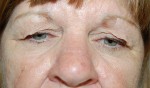 Eyelid Surgery - Blepharoplasty