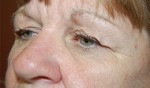 Eyelid Surgery - Blepharoplasty