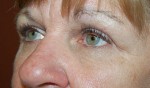 Eyelid Surgery - Blepharoplasty