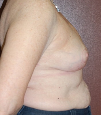 Breast Asymmetry