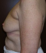 Breast Asymmetry