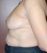 Breast Asymmetry