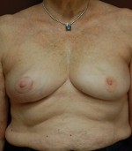 Breast Asymmetry