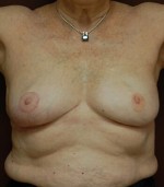 Breast Asymmetry