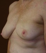 Breast Asymmetry