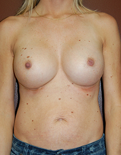 Breast Asymmetry