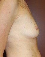 Breast Asymmetry