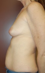Breast Asymmetry