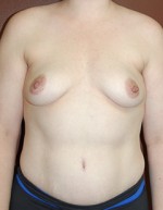 Breast Augmentation