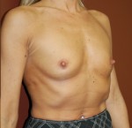 Breast Augmentation