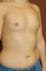 Breast Augmentation