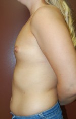Breast Augmentation