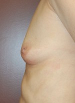 Breast Augmentation