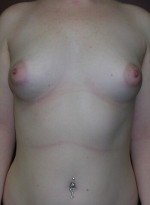 Breast Augmentation