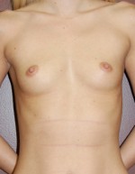 Breast Augmentation