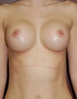 Breast Augmentation