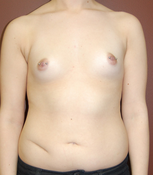 Breast Augmentation