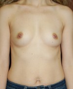 Breast Augmentation