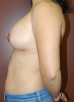 Breast Augmentation