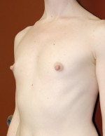 Breast Augmentation