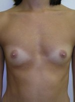 Breast Augmentation