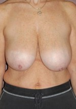 Breast Lift