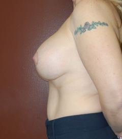 Breast Lift with Augmentation