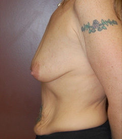 Breast Lift with Augmentation