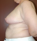 Breast Reduction