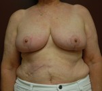 Breast Reduction