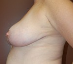 Breast Reduction